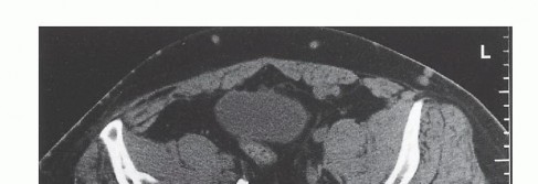 Illustration 8 for Surgical Pelvic Resection: Gluteus Maximus Muscle & Nerve Preservation