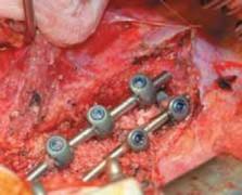 Illustration 49 for Mastering Anterior Interbody Arthrodesis with Instrumentation for Scoliosis