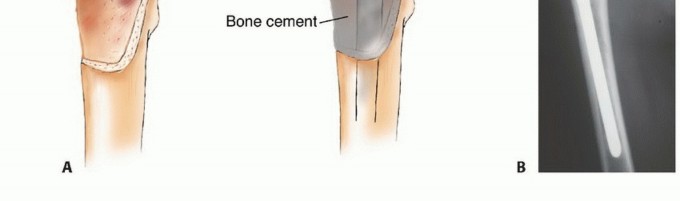 Illustration 29 for Plain Radiograph Showing MBD: Surgical Planning to Prevent Failures