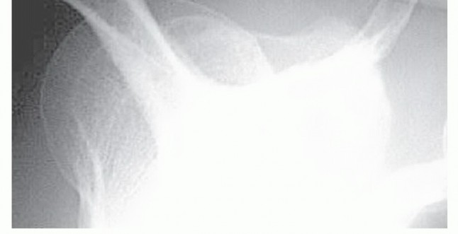 Illustration 2 for Find Relief: Arthroscopic Subacromial Decompression for Impingement