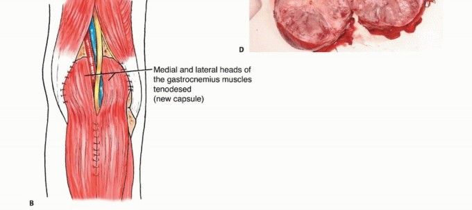 Illustration 20 for Complex Popliteal Resections: Protecting the Greater Saphenous Vein