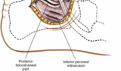 Illustration 116 for Optimized Approaches to the Dorsum of the Foot & Ankle