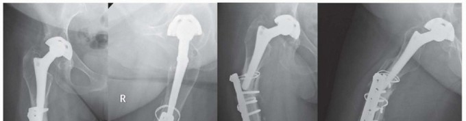 Illustration 9 for Mastering Fixation of Periprosthetic Fractures of the Femur