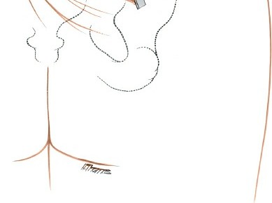 Illustration 7 for Simple & Safe Posterior Approach to the Sacroiliac: Key Techniques