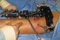 Illustration 9 for Conquering Adolescent Blount's Disease: A Surgical Guide