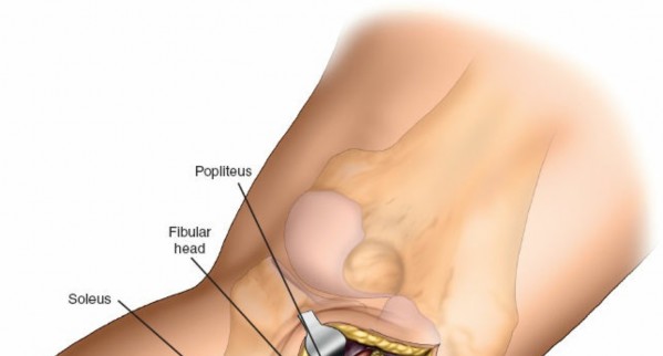 Illustration 32 for Surgical Access: Mastering the Tibia's Surface & Fibula Approaches