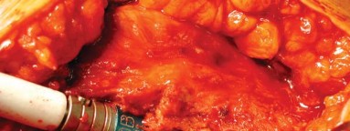 Illustration 16 for S-ROM: Inside the Technique of Modular Implant Design