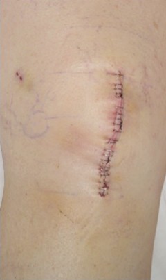 Illustration 14 for Minimal Incision Total Knee: Experience Faster Healing