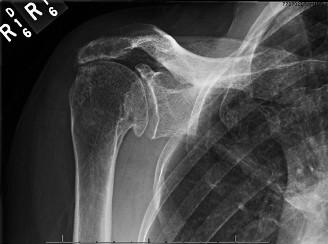 Rotator Cuff Arthropathy: Decode the Diagnosis from a Case Study