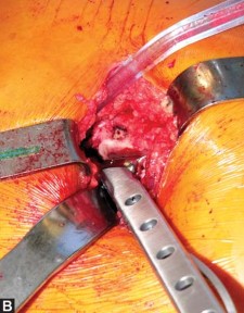 Illustration 49 for Exploring the Ambulatory Surgical Setting for Total Hip Replacement