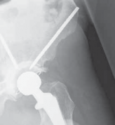 Illustration 3 for Advanced Arthroplasty for Malignant Lesions: Reclaim Your Mobility