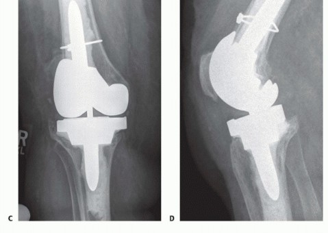 Illustration 6 for Tibial Bone Loss in TKA Revision: Augments for Complex Cases