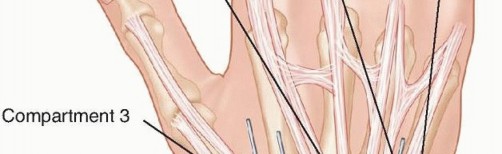 Illustration 7 for Effective K-Wire Fixation: Distal Radius Fractures Without External Fixation