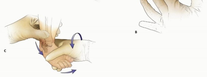 Comprehensive Treatment of Vertical Talus: What Works