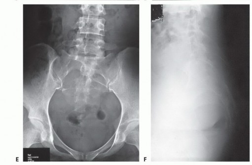 Illustration 17 for Sacral Tumor Surgery: Safeguarding Bowel & Bladder Control