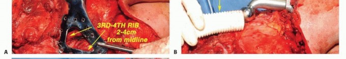 Illustration 10 for Mastering Total Scapular Resections: Reconstruction & Outcomes