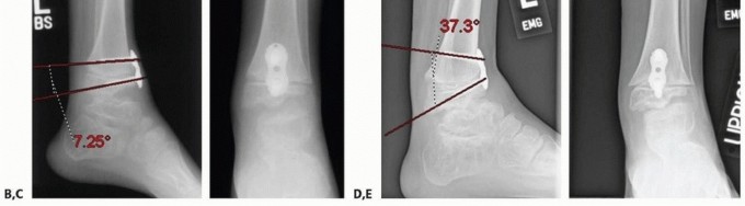 Illustration 10 for Optimizing Growth to Correct Pediatric Limb Deformities