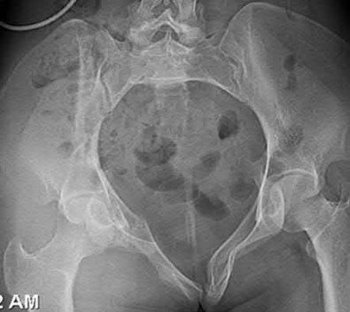 Illustration 135 for OrthoCash: Trauma MCQs & Cases for a yearold woman
