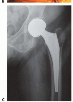 Illustration 43 for Hemiarthroplasty of the Hip: Indications & Types Explained