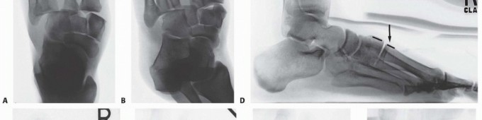 Illustration 5 for Fixation of Lisfranc Injuries: Essential Open Reduction Guide
