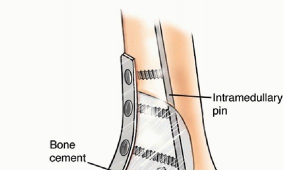 Illustration 42 for Restore Vital Function: Surgery for Type II Humeral Metastasis