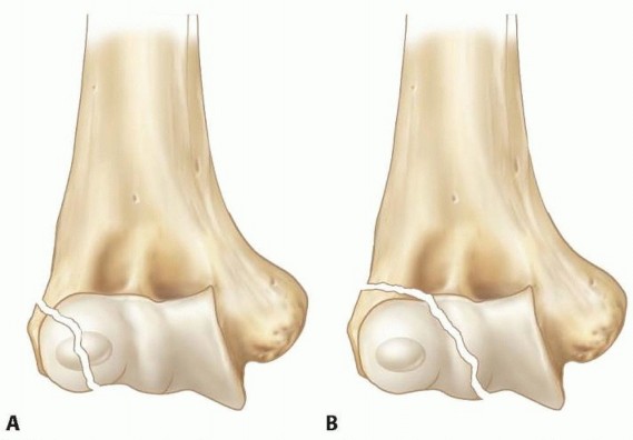Displaced Lateral Condyle Fractures: OR/IF Techniques & Insights