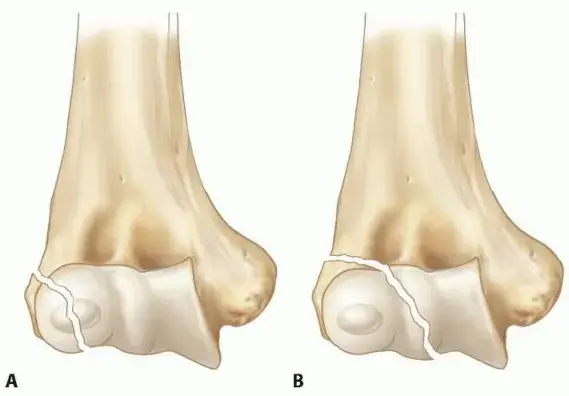 صورة توضيحية لـ كسور الكوع عند الأطفال: دليل شامل لكسور اللقمة الوحشية وعلاجها المتقدم مع الدكتور محمد هطيف