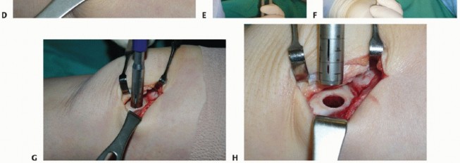 Illustration 25 for Painful Talus Lesions? The tech fig c Osteochondral Transfer Solution