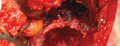 Illustration 44 for Unlock the Figure Posterior Approach to the Hip