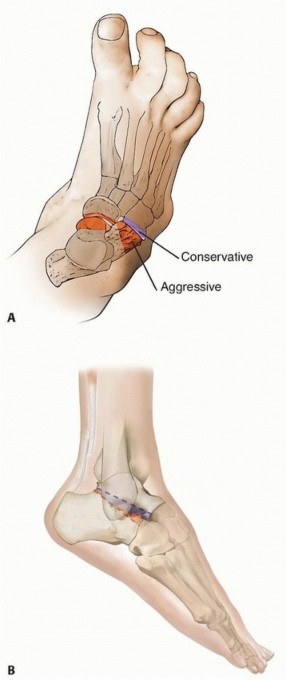 Illustration 3 for Expert Guide to Triple Arthrodesis et al. for Hindfoot