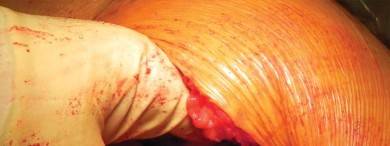 Illustration 52 for Unlock better THA: The technique of short stem for less invasiveness