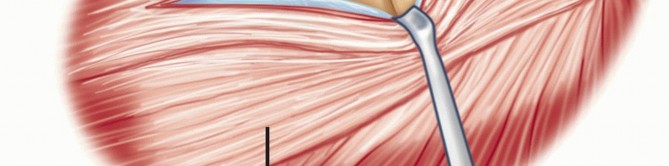 Illustration 13 for Radial Head Arthroplasty: Restoring Elbow Function & Stability