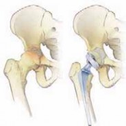 Illustration 6 for Advanced Arthroplasty for Malignant Lesions: Reclaim Your Mobility