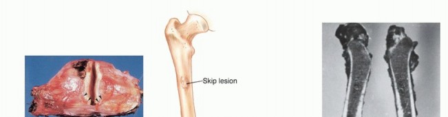 Understanding Benign Bone Tumors: Your Complete Preoperative Guide