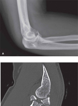 Terrible Triad Injury: Expert Guide to Diagnosis & Treatment