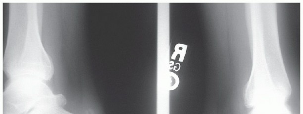 Illustration of hallucis longus tendon - Dr. Mohammed Hutaif