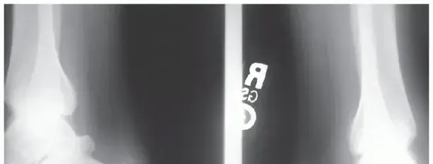 صورة توضيحية لـ التهاب وتر أخيل الإدخالي: دليلك الشامل للعلاج والتعافي في اليمن والخليج مع البروفيسور محمد هطيف