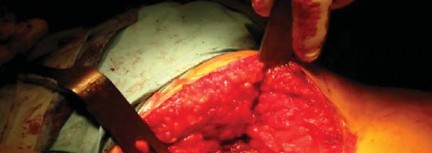 Illustration 21 for The Proxima: Why This Proximally Loading Implant Preserves Bone