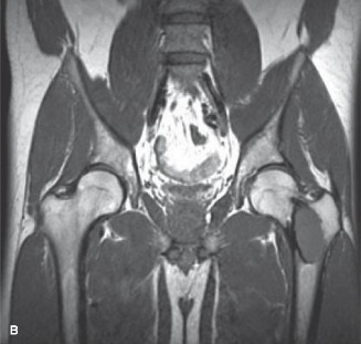 Illustration 2 for Fibrous Dysplasia: Key Insights from Oncology Cases