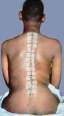 Illustration 26 for Optimizing Instrumentation for Neuromuscular Scoliosis