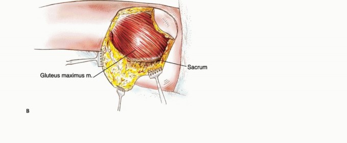Illustration 8 for Beyond Hemipelvectomy: Preservation of the Sciatic in Buttock Surgery