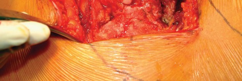 Illustration 54 for Direct Lateral Hip: Optimize Exposure with Sharp Curved Hohmann