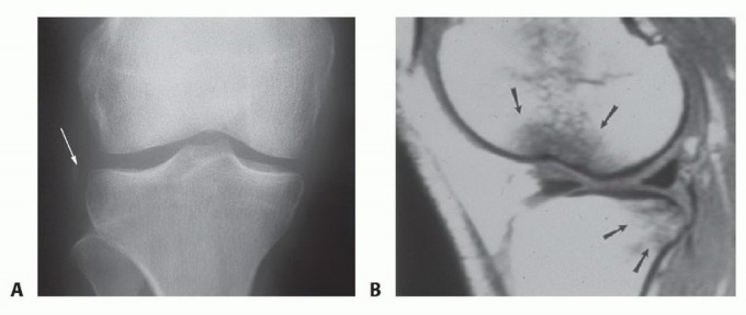 Patellar Tendon Graft for Single-Bundle ACL Reconstruction Explained