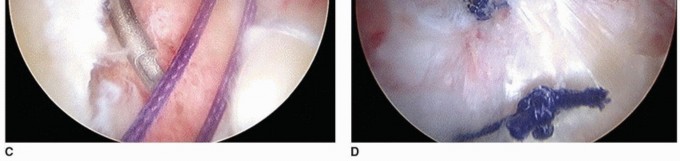 Illustration 37 for Beyond Knee Surg: Hip Arthroscopy for Sports Injuries