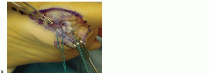 Illustration 29 for Restore Your Foot: Surgical Treatment for Hallux MP Joint Turf Toe