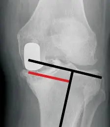 صورة توضيحية لـ التعويضات المعدنية في جراحة استبدال المفاصل فهم دورها وأهميتها
