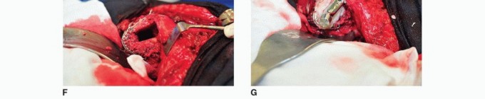 Illustration 41 for Cement in Cement Revision: Simplifying Complex Hip Revisions