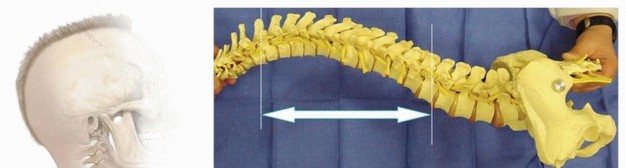 Illustration 19 for Duchenne Muscular Dystrophy: Is Spinal Fusion the Answer?