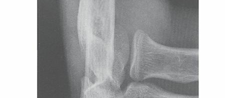 Illustration of radial head fractures - Dr. Mohammed Hutaif