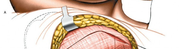 Illustration 176 for Unlocking Every Aspect of the Hip's Surgical Approaches